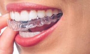 Invisalign in Suwanee